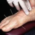 acupuncture